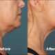 Kybella vs. Liposuccion du Cou Menton vs. Quantum RF