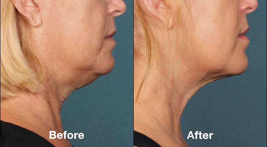 Kybella vs. Liposuccion du Cou Menton vs. Quantum RF