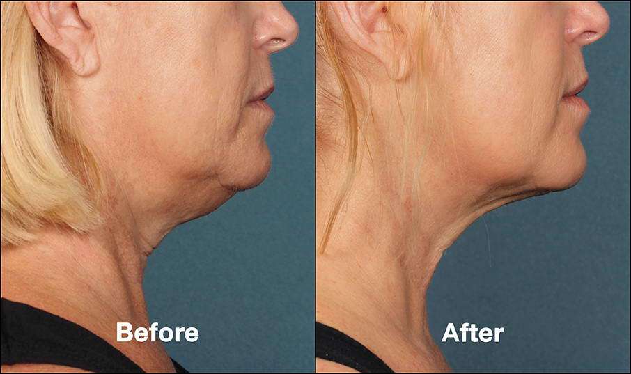 Kybella vs. Liposuccion du Cou Menton vs. Quantum RF