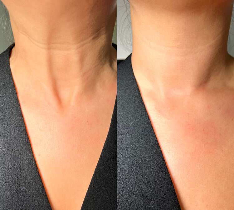 nefertiti-neck-lift