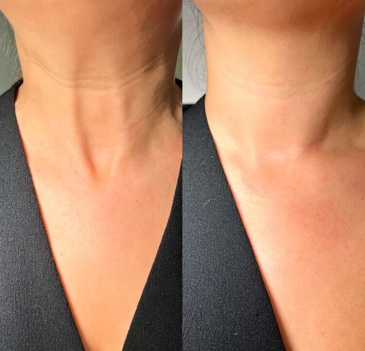 nefertiti-neck-lift