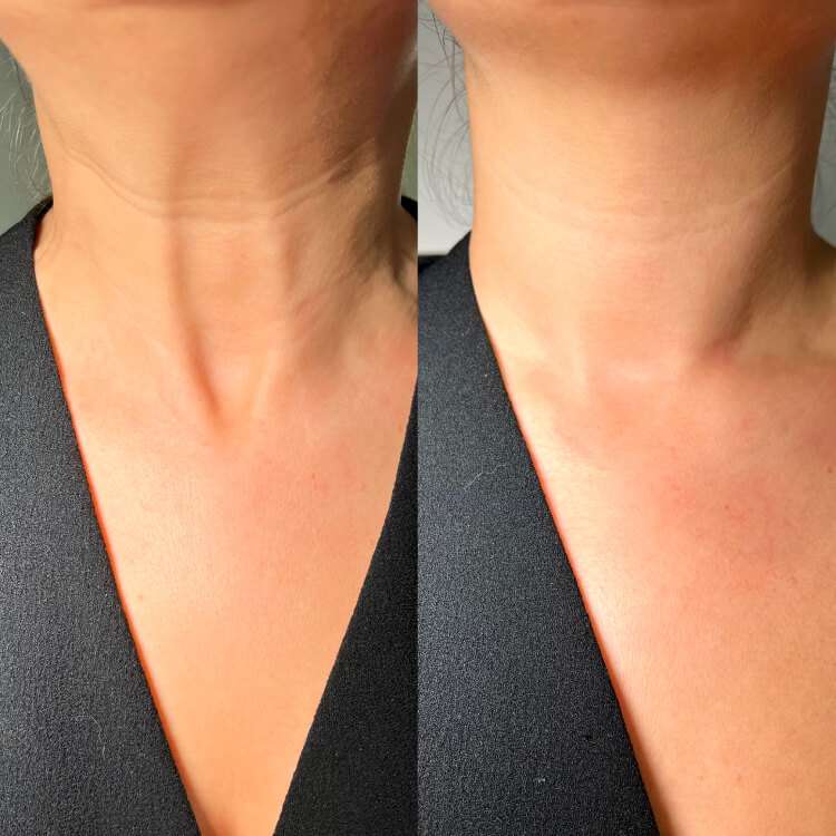 nefertiti-neck-lift