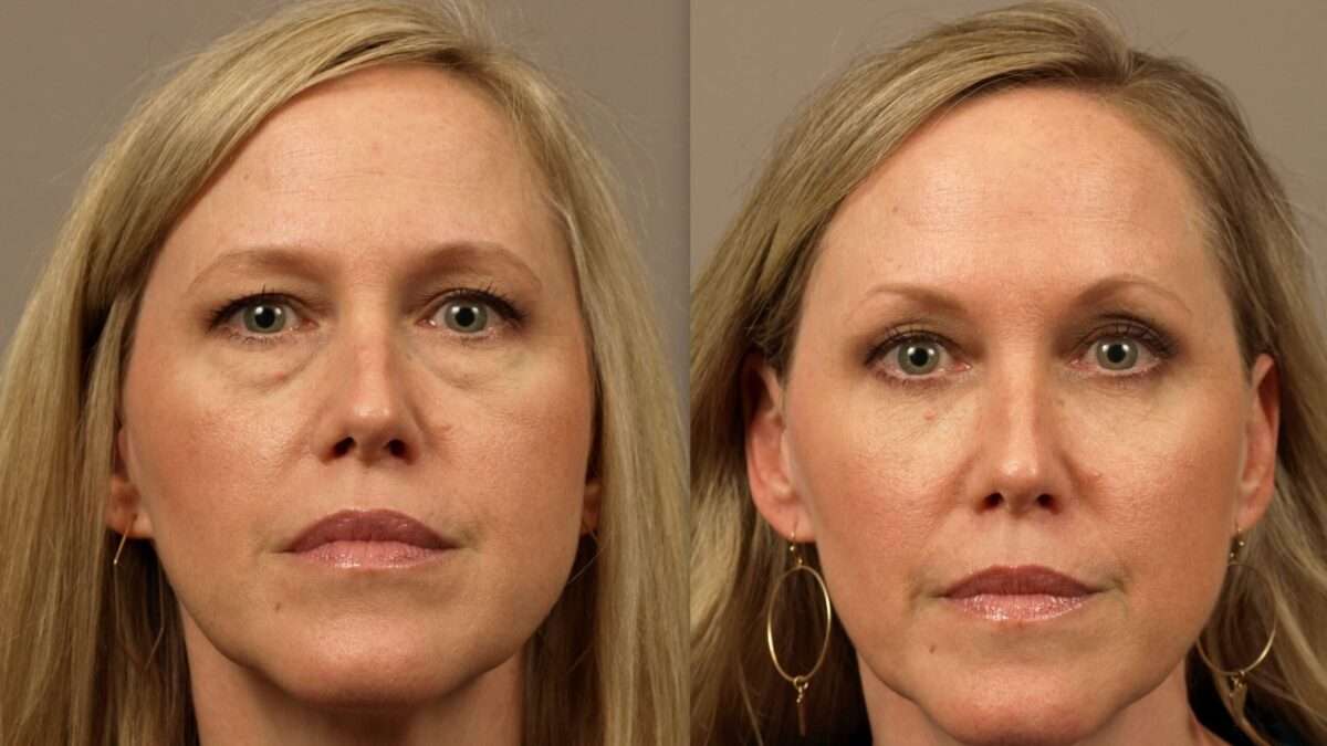Tear Trough Implants surgery