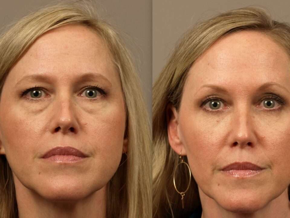 Tear Trough Implants surgery