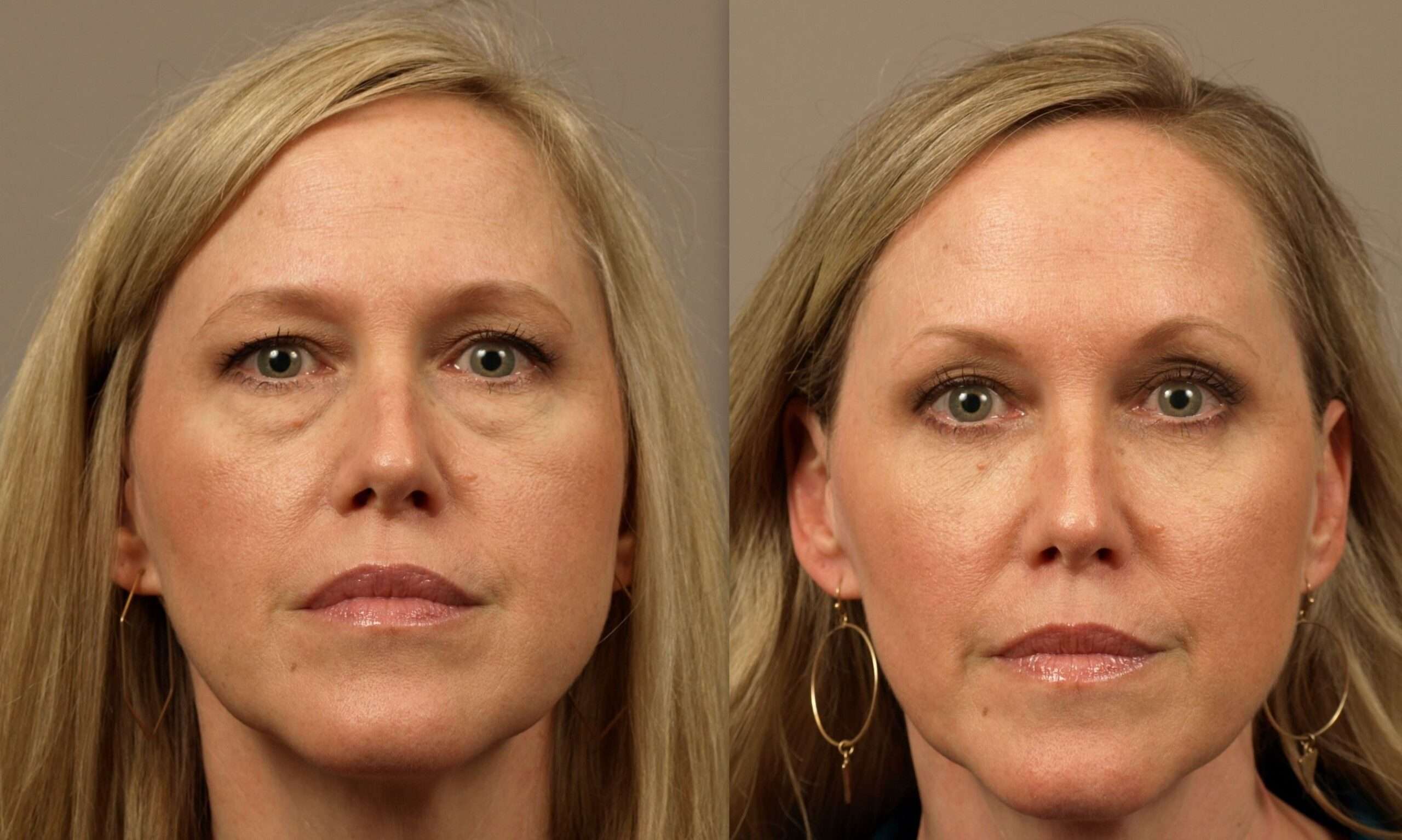 Tear Trough Implants surgery