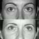 blepharoplastie endoscopique