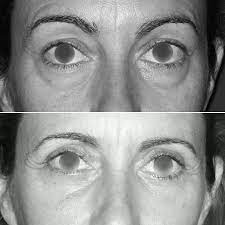 blepharoplastie endoscopique