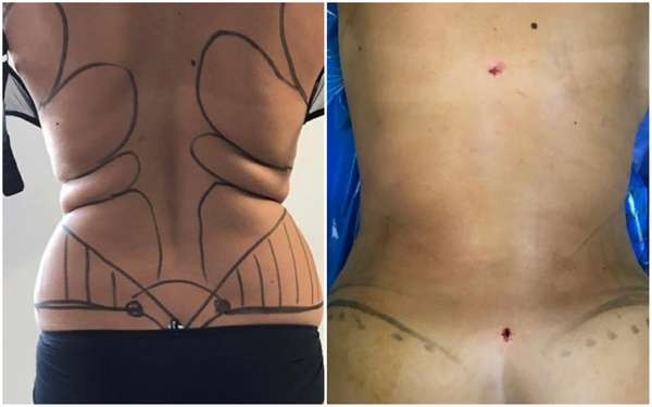 liposuccion 360 hd ou mega lipo