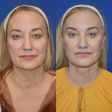 Deep Structural Neck Lift