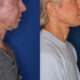 deep plane facelift for men
