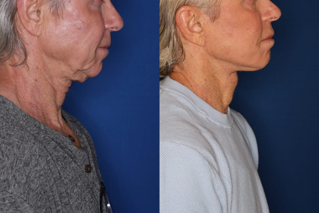 deep plane facelift for men