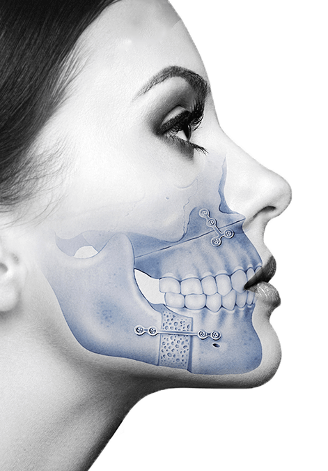 peek implant for gonial angles