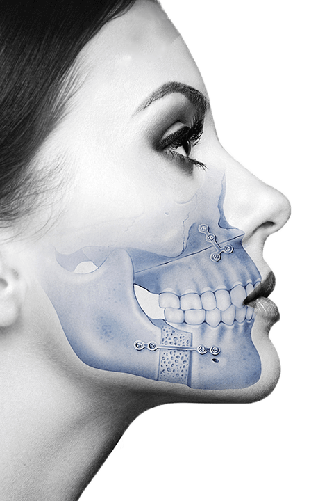 peek implant for gonial angles