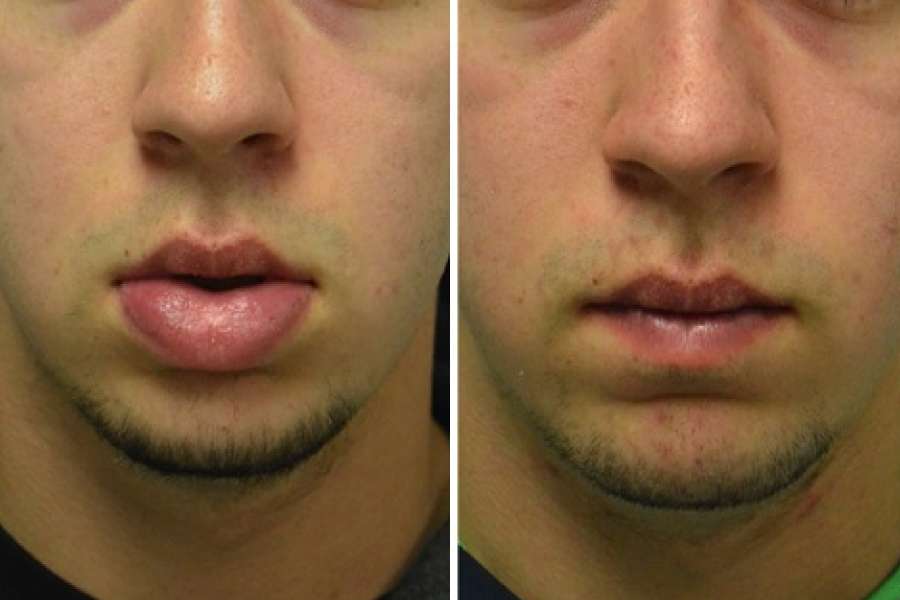 lip reduction surgery