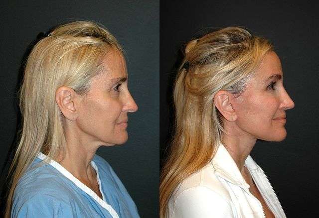 deep plane facelift with full structural restauration